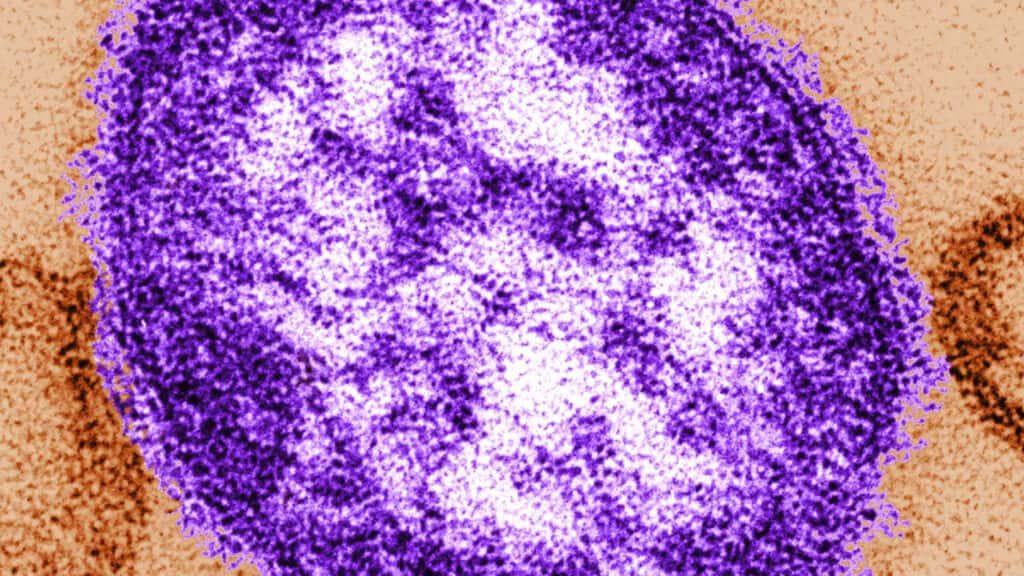 Forense de Pensilvania confirma que el virus del sarampión causó la muerte de un bebé en brote
