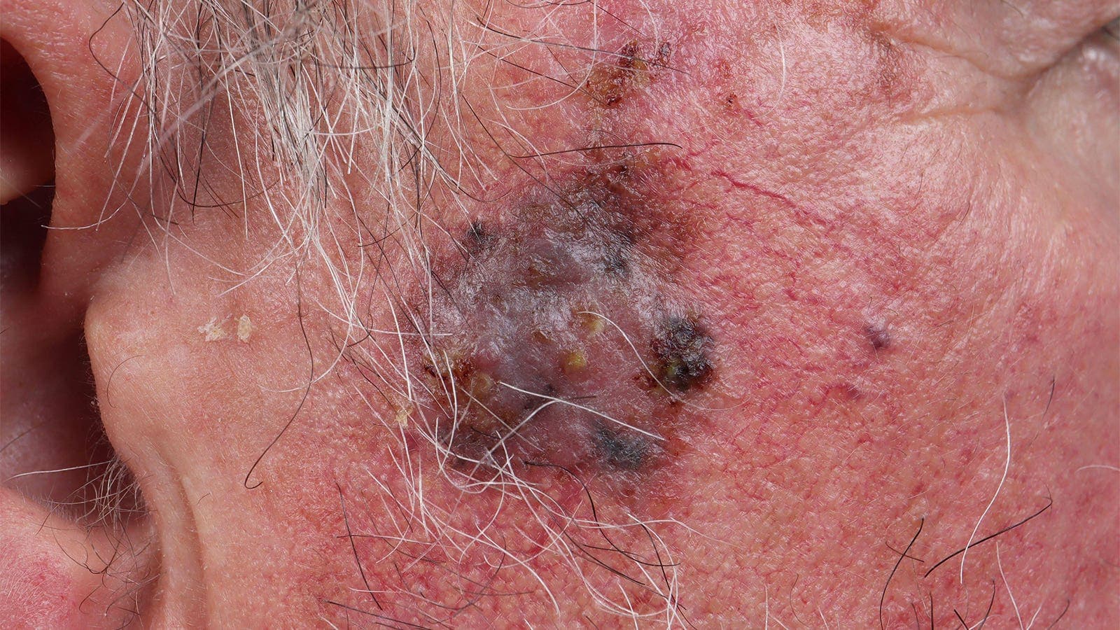 Fármaco para melanoma rechazado dos veces recibe apoyo sorpresa del panel de la FDA