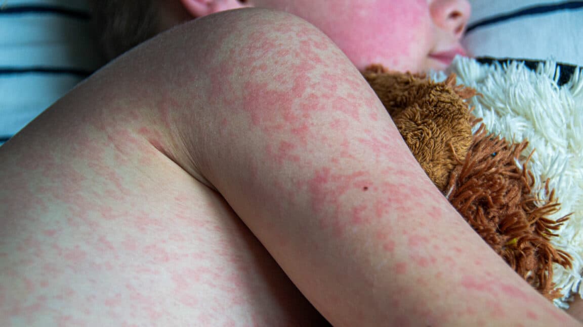 Two unvaccinated people die from measles in Pennsylvania
