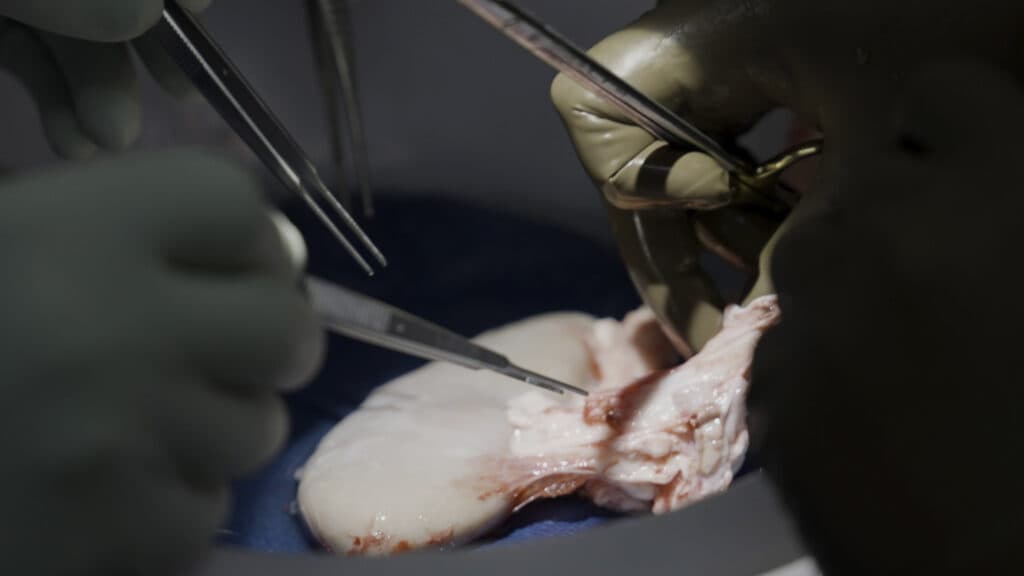 Gene-Edited Pig Kidney Recipients Successfully Transition to Human Organ Transplants