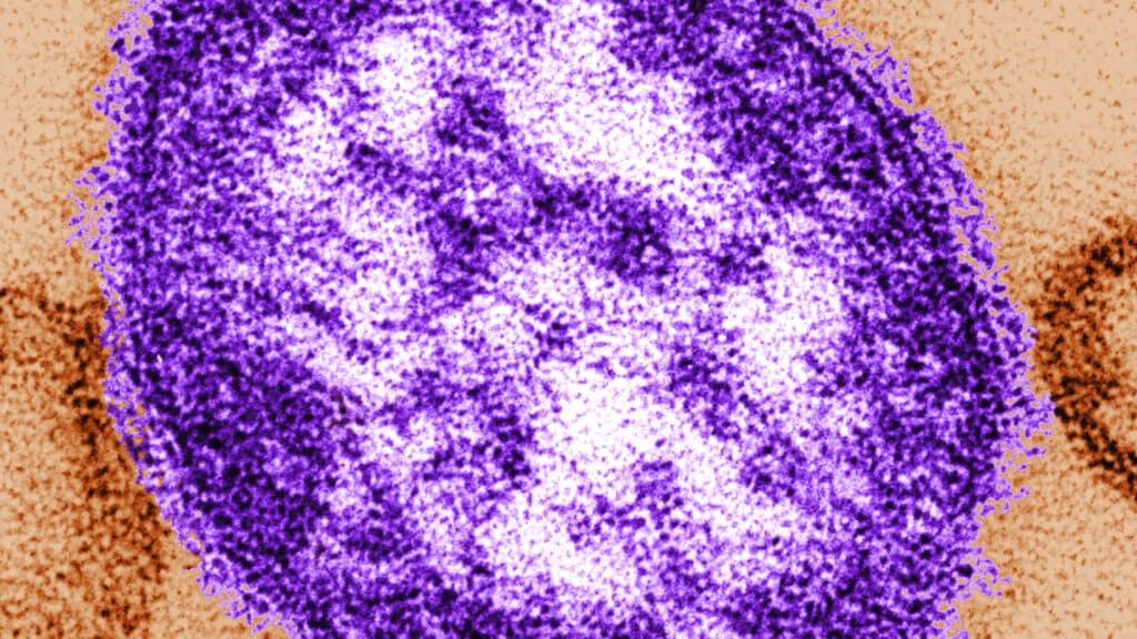 Forense de Pensilvania confirma que el virus del sarampión causó la muerte de un bebé en brote
