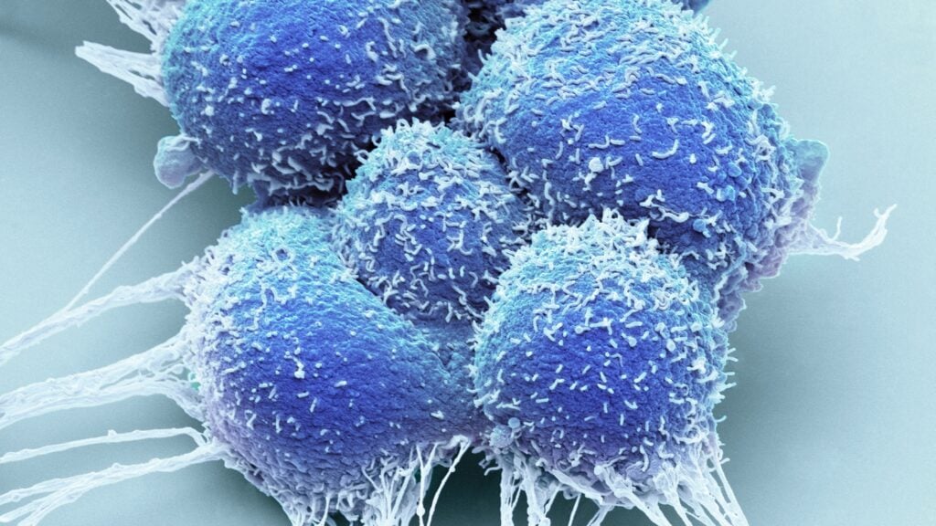 La terapia focal para el cáncer de próstata localizado ha dividido a los médicos. ¿Cambiarán de opinión con nuevos datos?