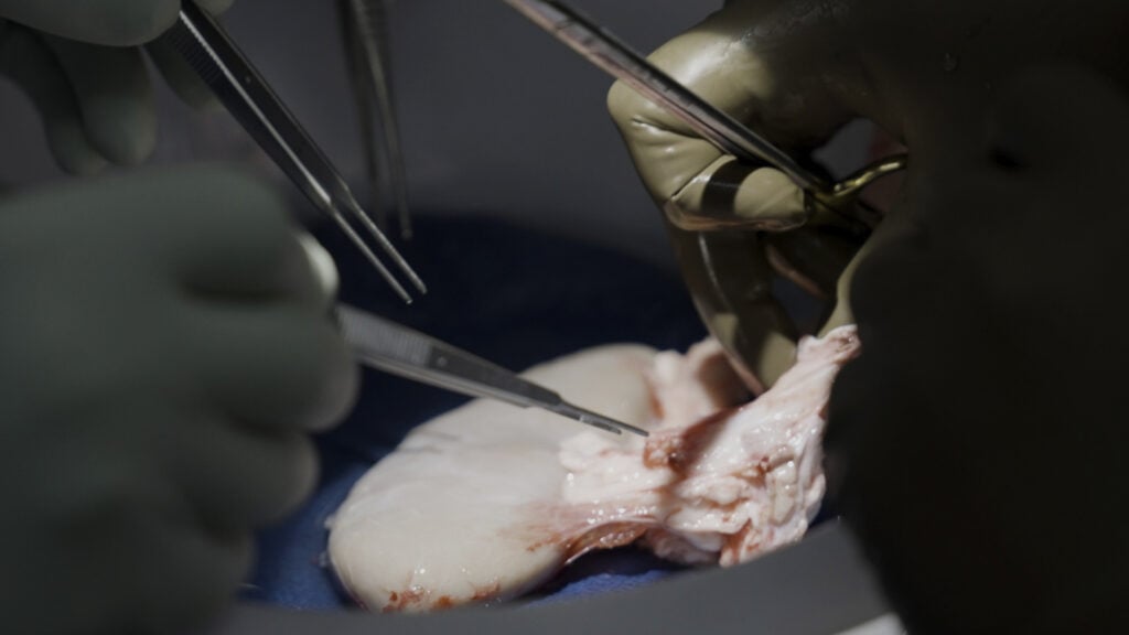Gene-Edited Pig Kidney Recipients Successfully Transition to Human Organ Transplants