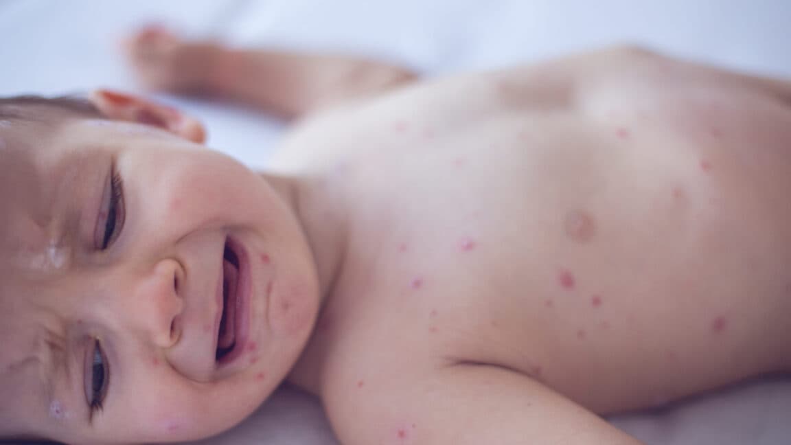 Coroner Confirms Measles Death of 6-Week-Old Infant as RFK Jr. Disputes Fatalities