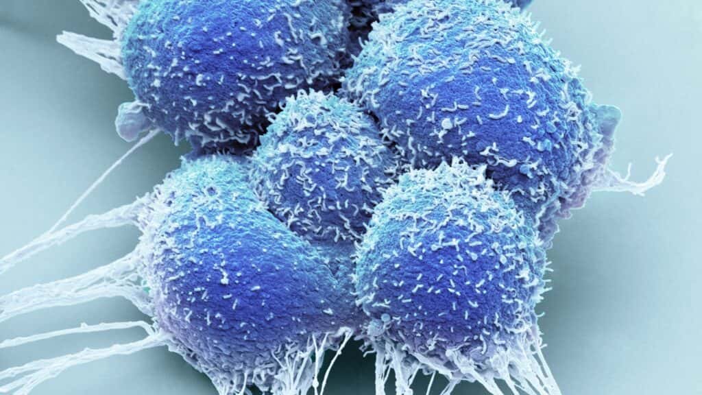 Focal therapy for localized prostate cancer has divided physicians. Will new data change minds?
