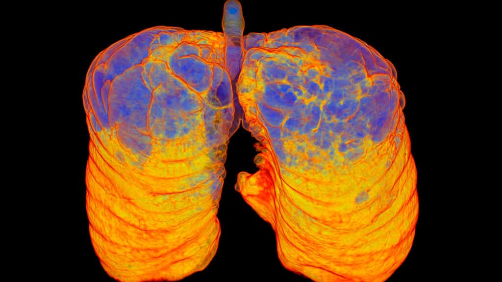 AstraZeneca's Experimental COPD Treatment Shows Strong Results in Late-Stage Studies